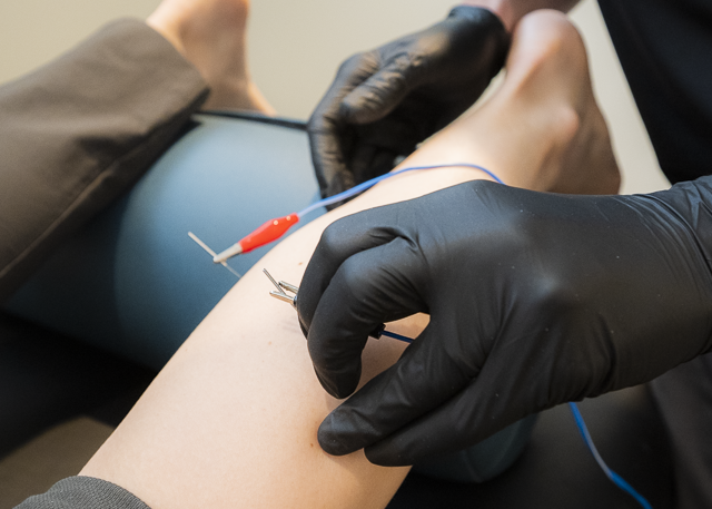 Dry Needling at Broken Arrow LifeMotion - LifeMotion