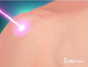 high intensity laser therapy